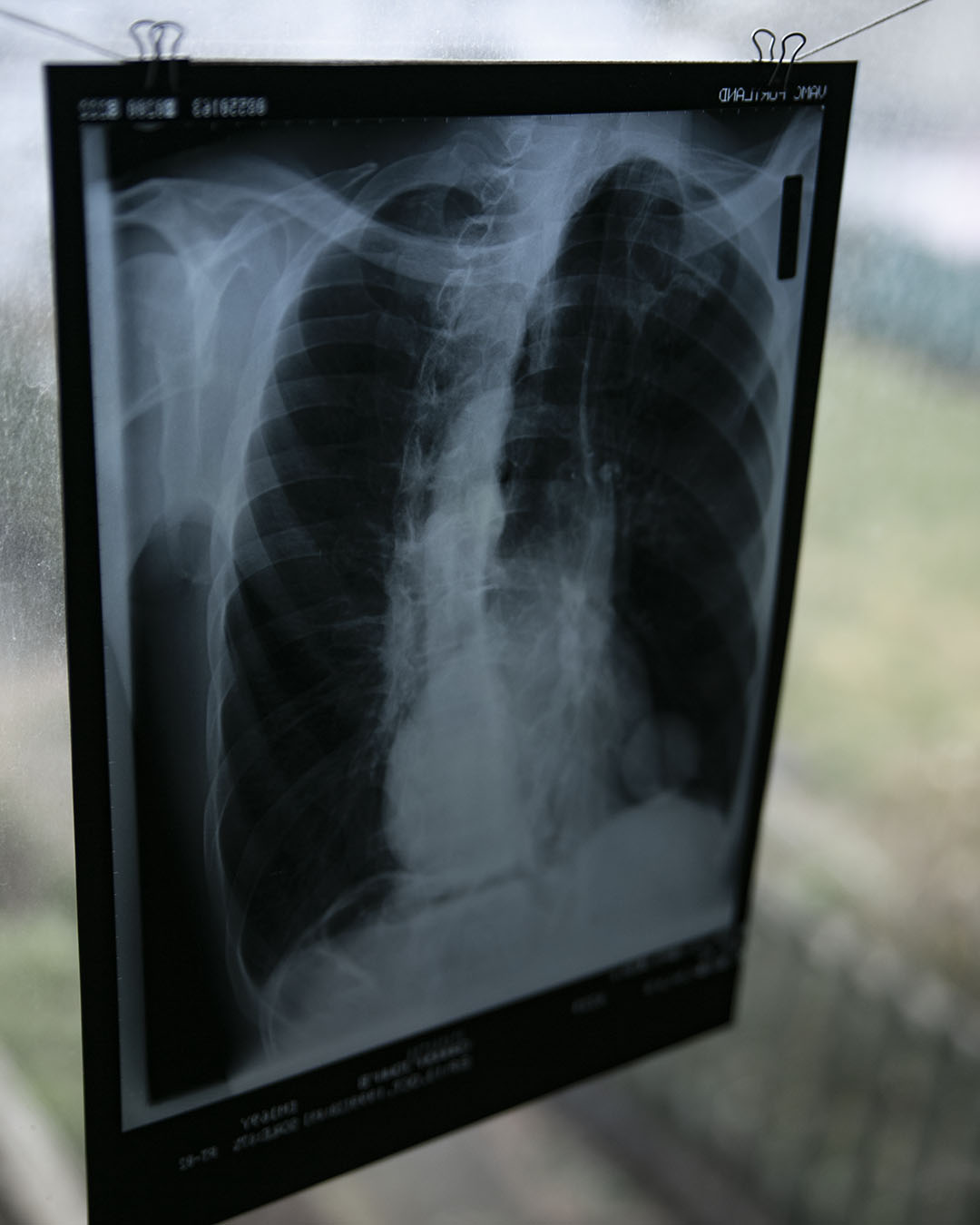 Vintage Chest X-Ray