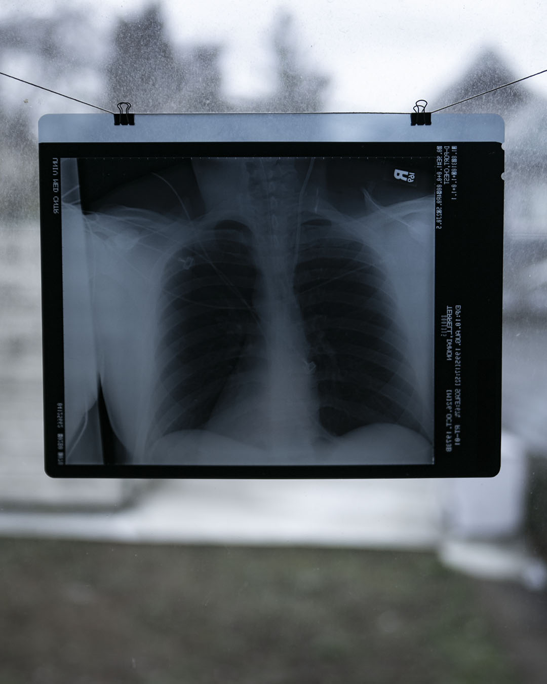 Vintage Chest X-Ray